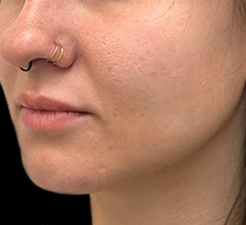 DERMAL FILLERS – Woman #8 - Before