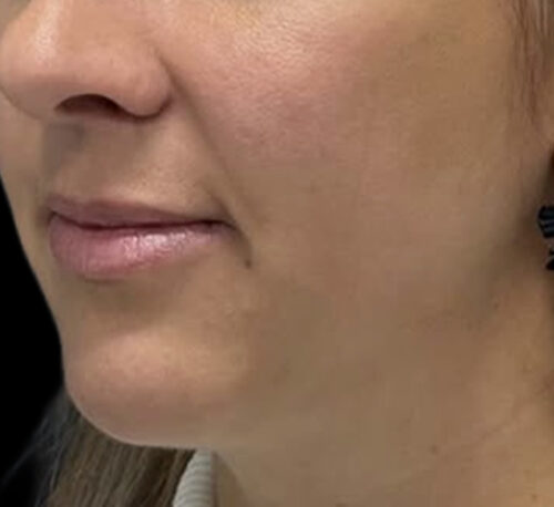 DERMAL FILLERS – Femme #9 - Après