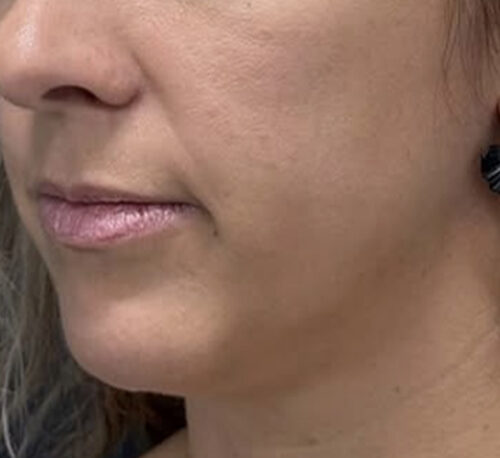 DERMAL FILLERS – Femme #9 - Avant