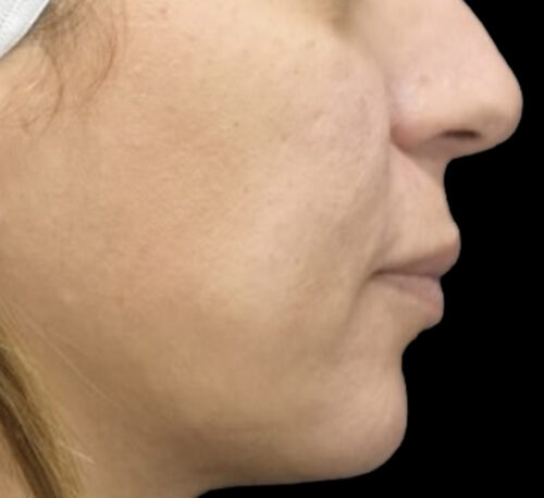 DERMAL FILLERS – Femme #11 - Après