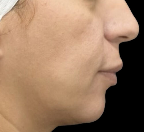 DERMAL FILLERS – Femme #11 - Avant