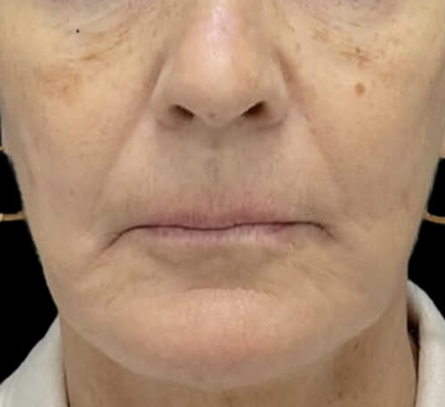 DERMAL FILLERS – Femme #12 - Après