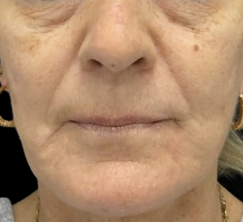 DERMAL FILLERS – Femme #12 - Avant