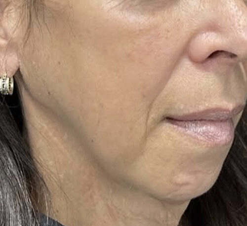 DERMAL FILLERS – Femme #13 - Après