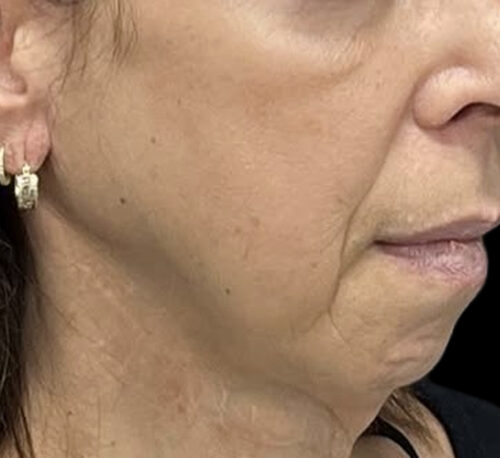 DERMAL FILLERS – Femme #13 - Avant