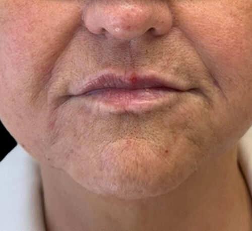DERMAL FILLERS – Woman #10 - After