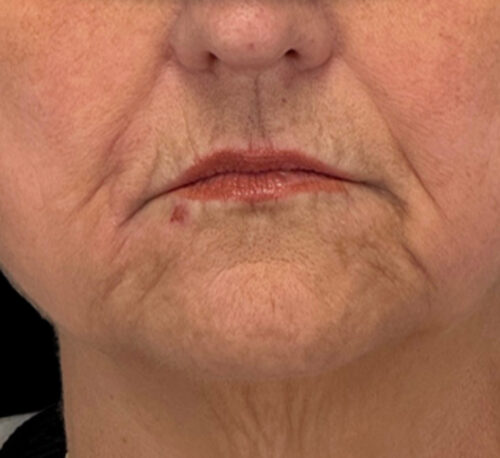 DERMAL FILLERS – Woman #10 - Before