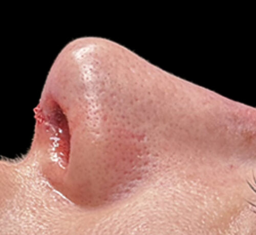 RHINOPLASTY – Femme #1 - Après