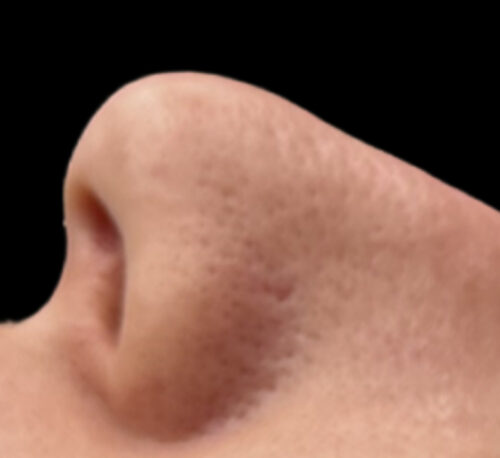 RHINOPLASTY – Femme #1 - Avant
